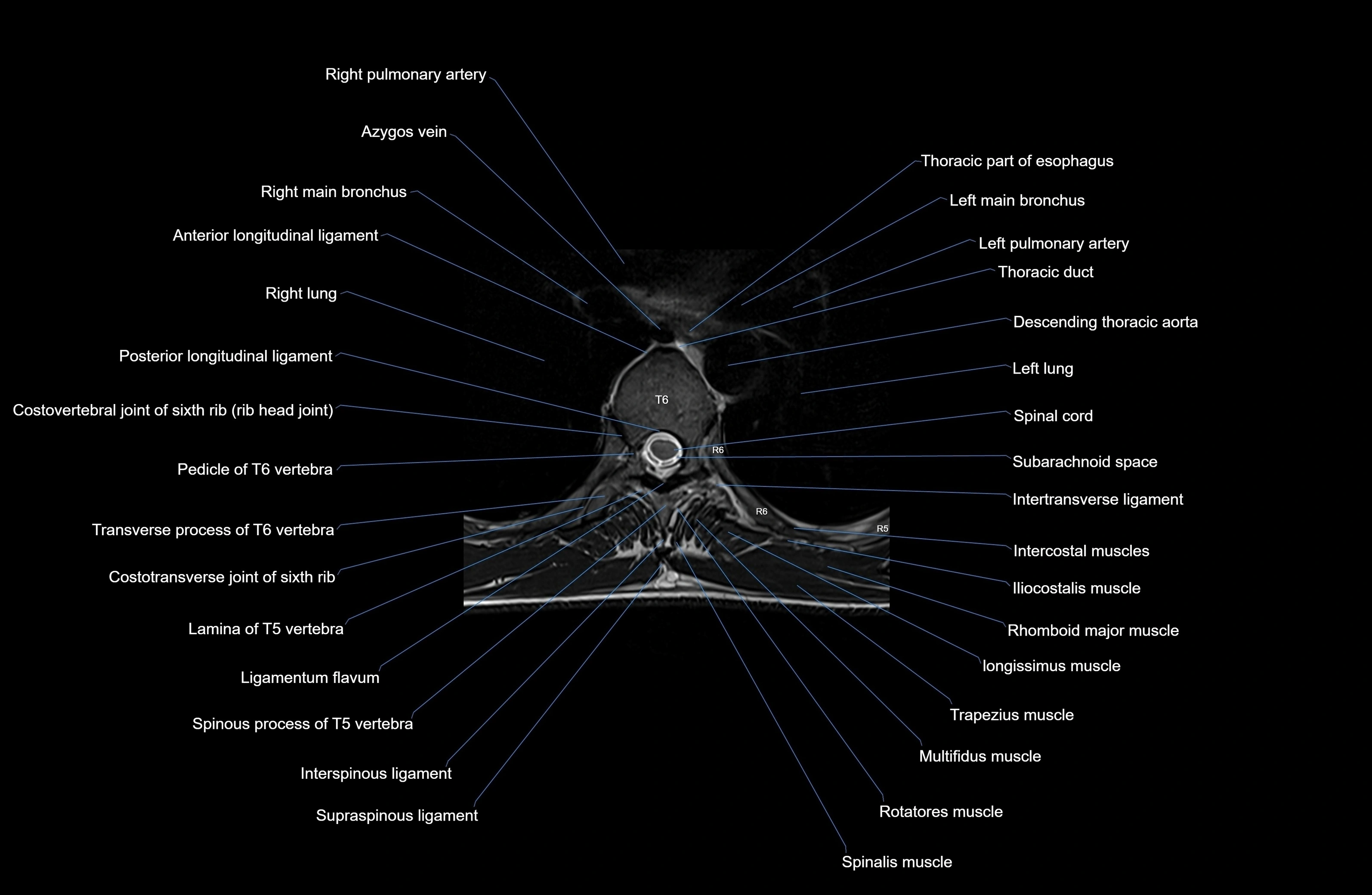 MRI thoracic spine axial  cross sectional anatomy 3T radiology  image-img-00001-00037.webp